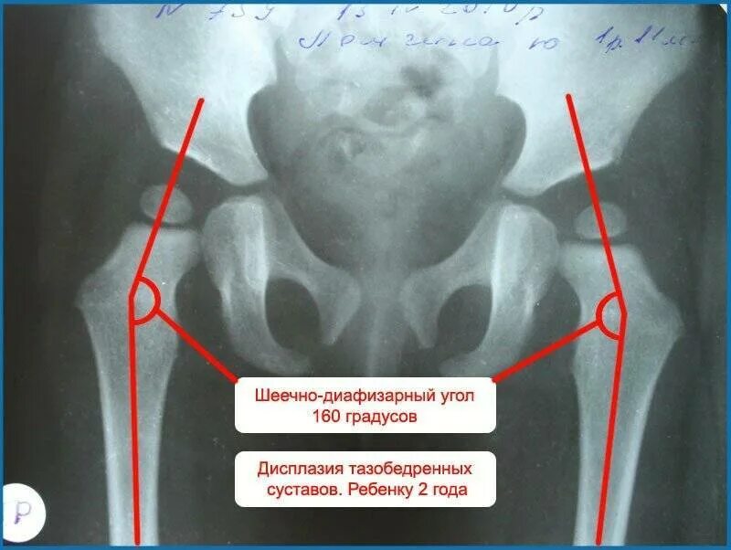 Дисплазия сустава у новорожденного лечение