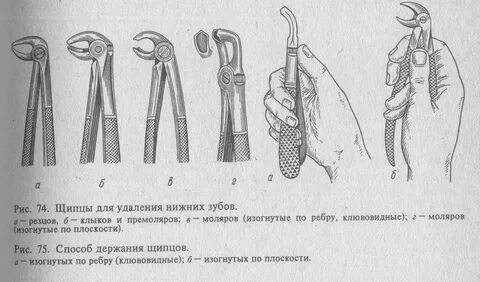 Удаление верхнего зуба элеватором