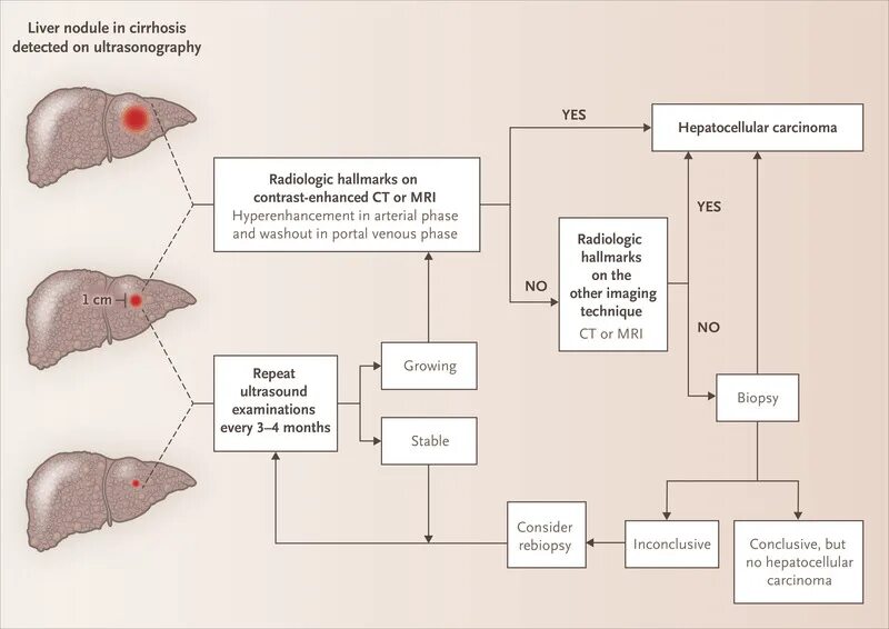 Печень в 4 года. Hepatocellular carcinoma Pathology outline.