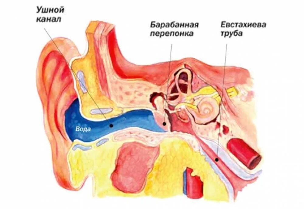 Глубокая ушная раковина. Попадания воды в среднее ухо.