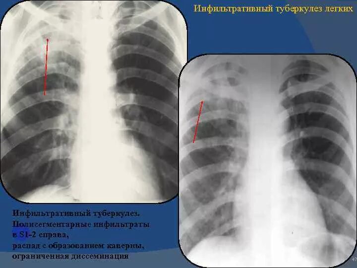 S 1 легкого. Инфильтративный туберкулез легкого с1-2. Инфильтративный туберкулез рентген. Инфильтративный туберкулез легких s2. Очаговый туберкулез в фазе инфильтрации рентген.