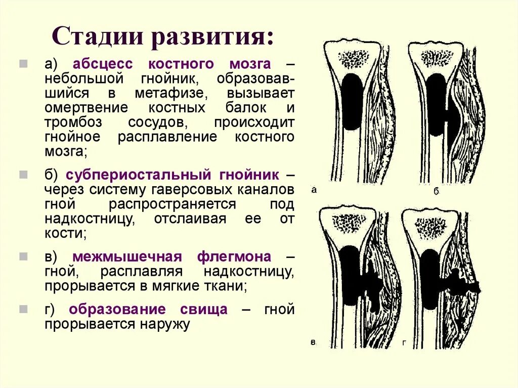 Гнойные заболевания суставов. Стадии развития абсцесса. Этапы формирования абсцесса. Абсцесс этапы развития. Этапы развития абсцесса гнойника.