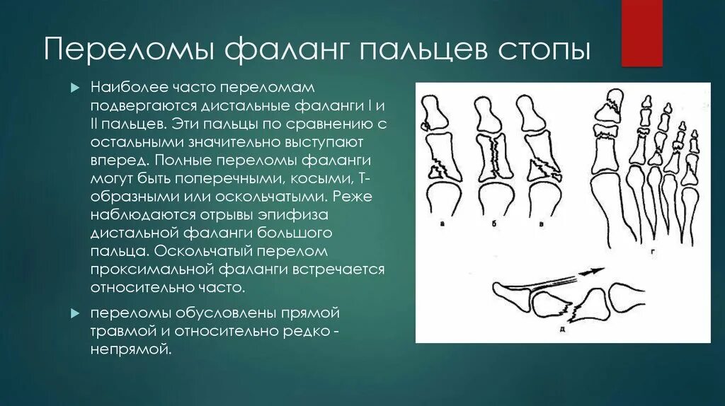 Основные фаланги стопы. Перелом основания проксимальной фаланги 1 пальца. Перелом дистальной фаланги 5 пальца. Перелом основания проксимальной фаланги 2 пальца левой стопы. Перелом дистальной фаланги мизинца стопы.