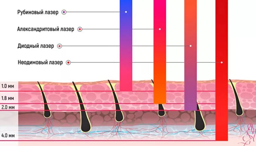 Сколько по времени длится лазерная. Диодный лазер глубина проникновения. Глубина проникновения александритового лазера. Глубина воздействия диодного лазера. Глубина воздействия лазера и глубина залегания волос.