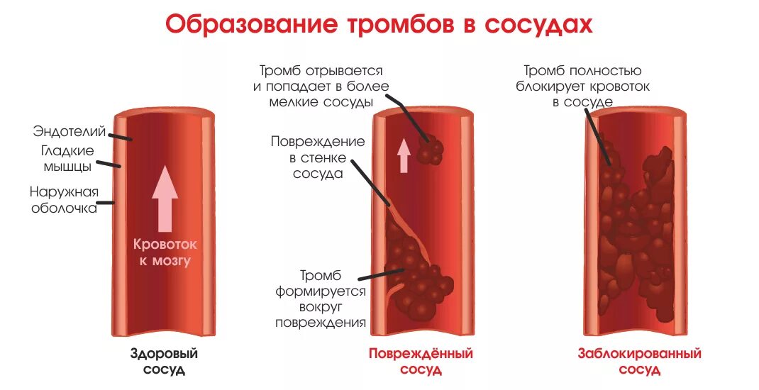 Тромбы в сосудах причины