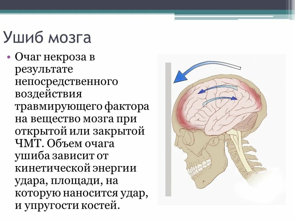 Небольшое сотрясение мозга. Ушиб головного мозга презентация. Степени головного мозга. Царапина по сравнению с сотрясением мозга