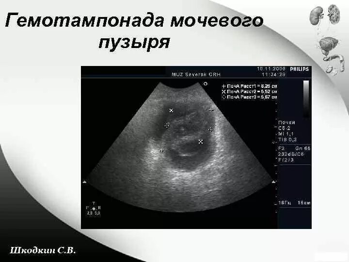 Тампонада мочевого пузыря на УЗИ. Ультразвуковое исследование (УЗИ) мочевого пузыря. Гемотампонада мочевого пузыря. Травма мочевого пузыря УЗИ.