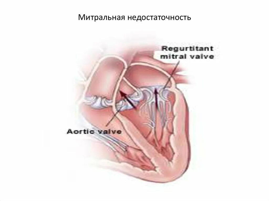 Сердечная недостаточность митрального клапана. Пороки сердца митральная недостаточность. Митральная недостаточность макропрепарат. Митральная недостаточность врожденный порок. Недостаточность митрального клапана мкб 10.