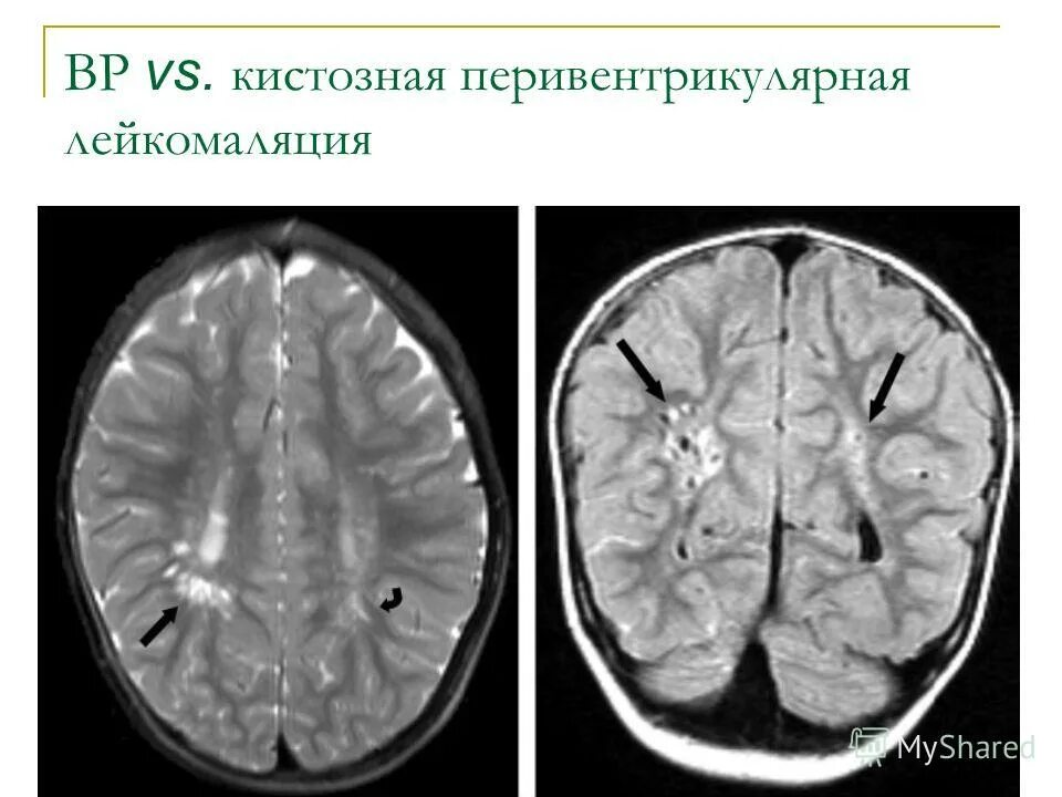 Дцп мозг. Пространства Вирхова-Робина мрт. Перивентрикулярные пространства Вирхова Робина. Кисты Вирхова Робина мрт. Перивентрикулярная лейкомаляция мрт.