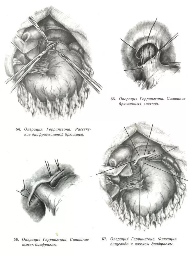 Операции на пищеводе. Диафрагмальная грыжа операция. Операции при грыжах пищеводного отверстия. Операция по Белси грыжи пищевода. Грыжа диафрагмы операция.