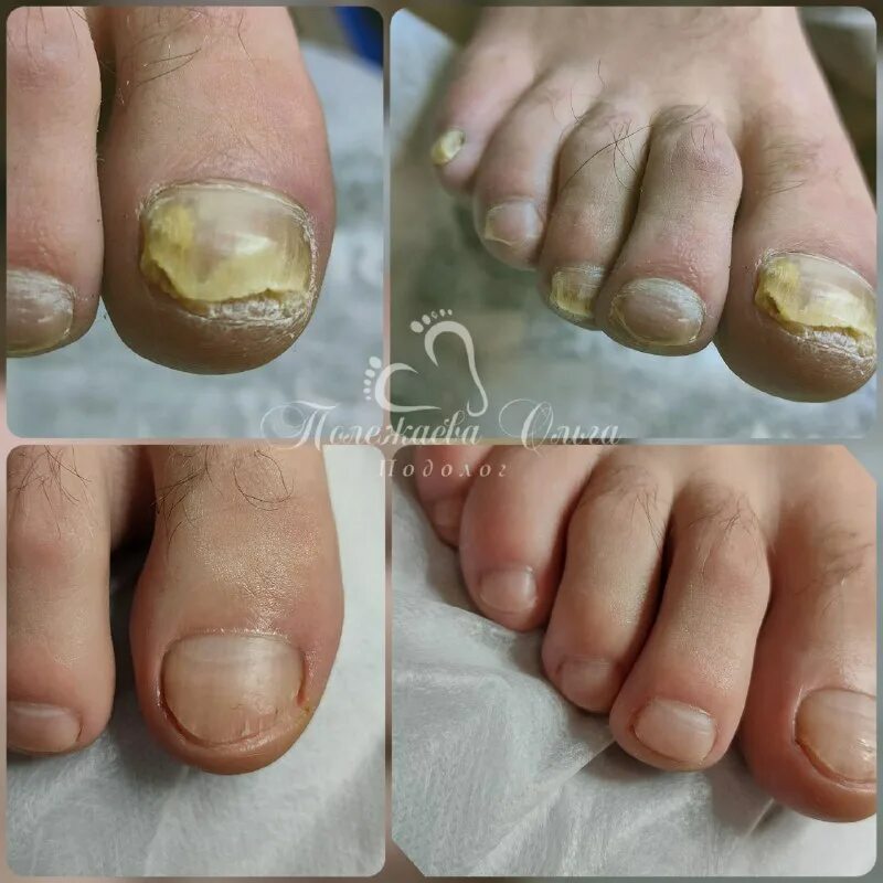 обработка вросшего ногтя. где лечить ноготь на ноге.