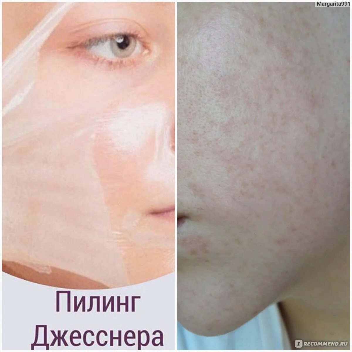 Пилинг джесснера при куперозе. Пилинг дже. Пилинг дже. 1. Peel medical пилинг химический jessner solution peel ph 2.