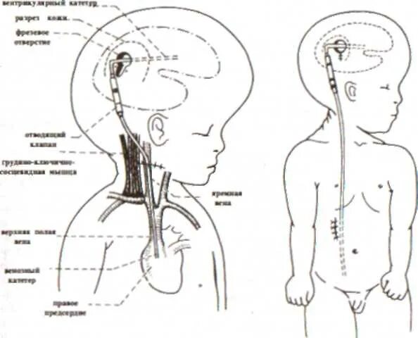 Шунт головного мозга при гидроцефалии. Шунт гидроцефалии схема. Гидроцефалия программируемый шунт. Шунтирование головного мозга при гидроцефалии у детей.