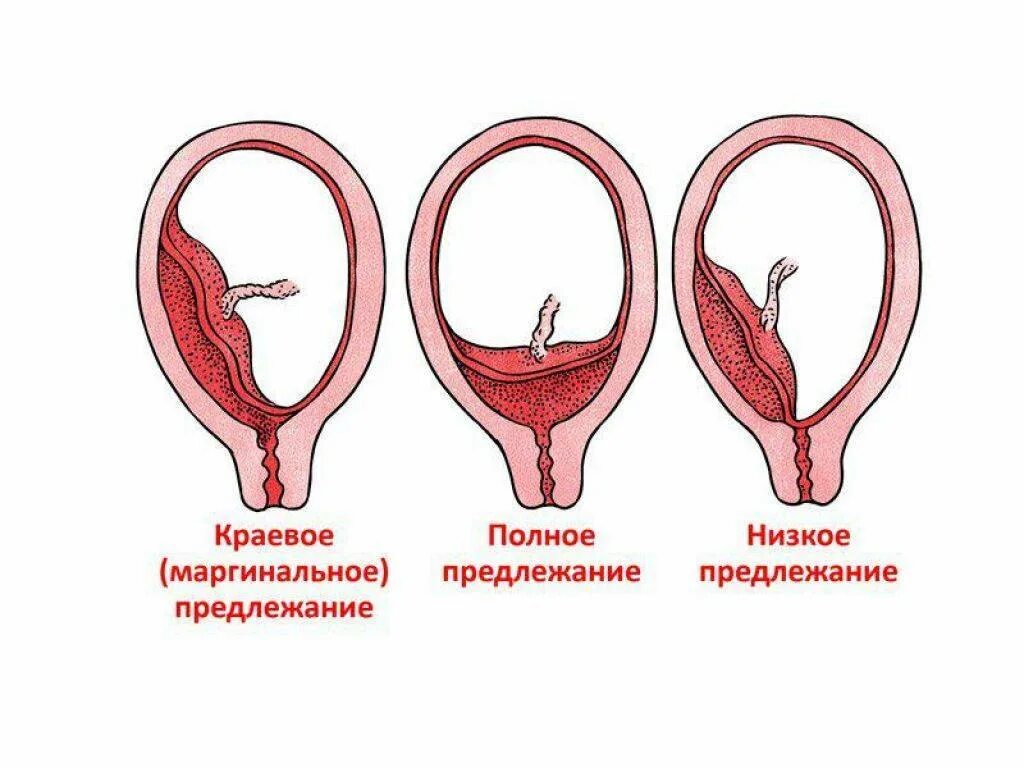 Полное предлежание форум. Типы прикрепления плаценты. Плацента краевое предлежание плаценты. Предлежание плаценты хориона. Полное и неполное предлежание плаценты.