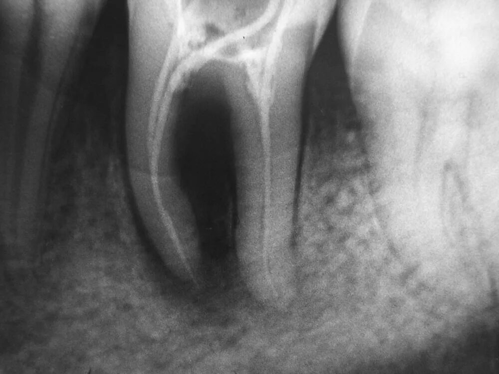 Периапикальный периодонтит. Маргинальный периодонтит. Периодонтит рентген снимок. Острый апикальный периодонтит рентгенограмма.