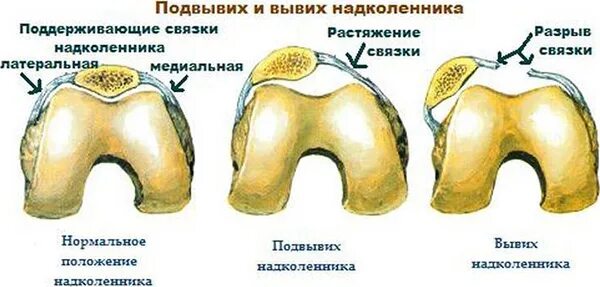 Подвывих головки тазобедренного сустава. Вывих плечевого сустава рентгенограмма. Подвывих головки тазобедренного сустава. Подвывих плечевого сустава мрт. Подвывих с6 позвонка рентген.