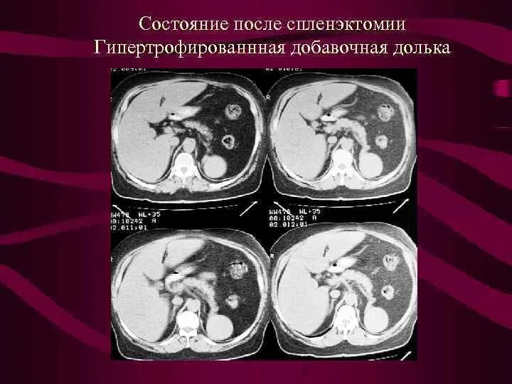 Добавочная долька селезенки на УЗИ. Добавочная долька селезенки на кт.