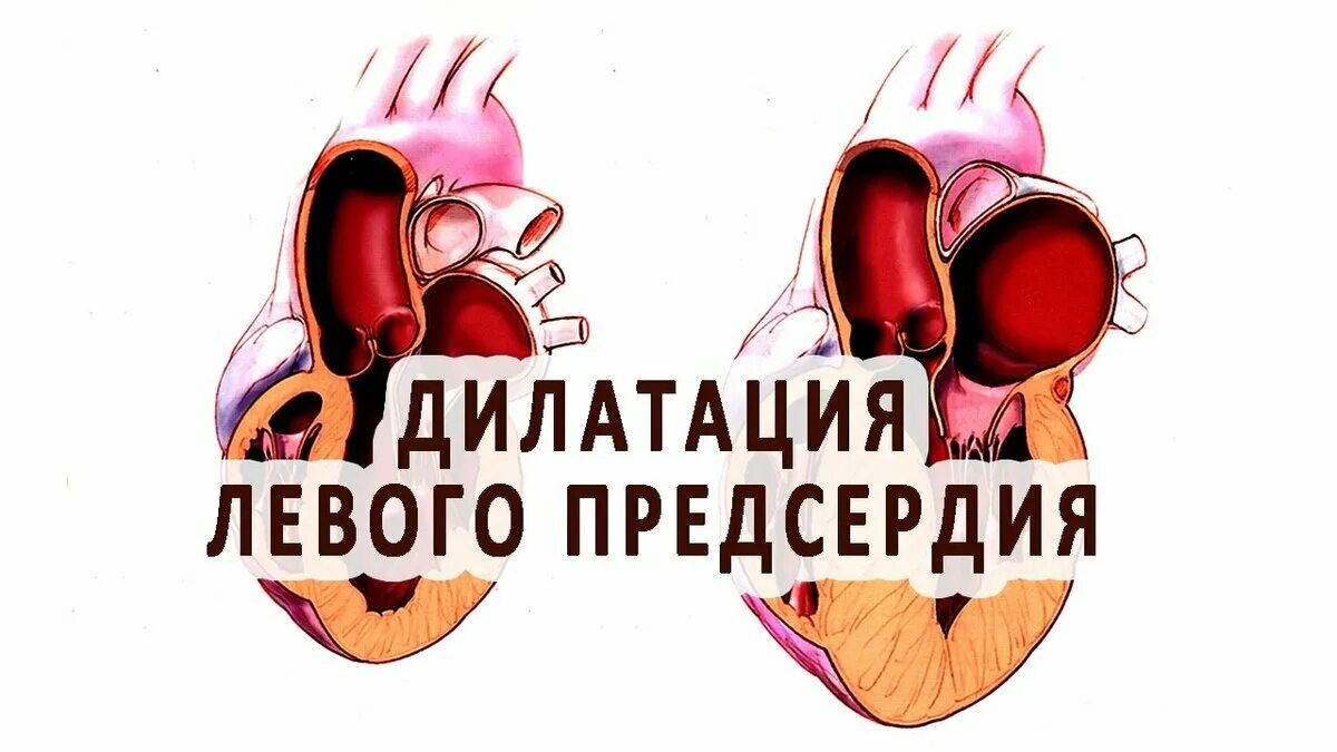 Дилатация левого предсердия. Дементация левого предсердия. Тоногенная дилатация сердца. Миогенная дилатация полостей сердца. Дилатация полостей предсердий