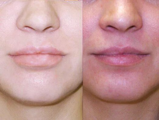 Двусторонняя хейлопластика. Уменьшение натуральных губ. Уменьшение губ до и после. Можно уменьшить губы