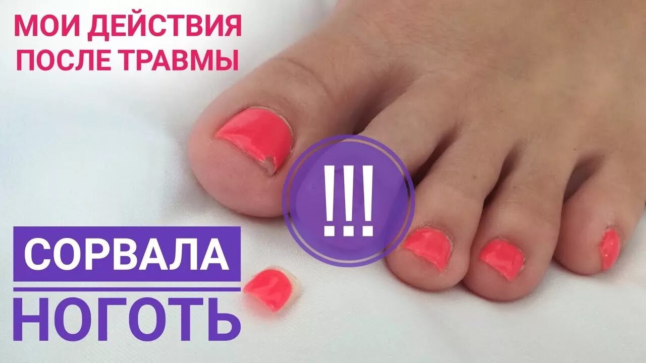 Оторванный ноготь как снять Pin on Health and fitness