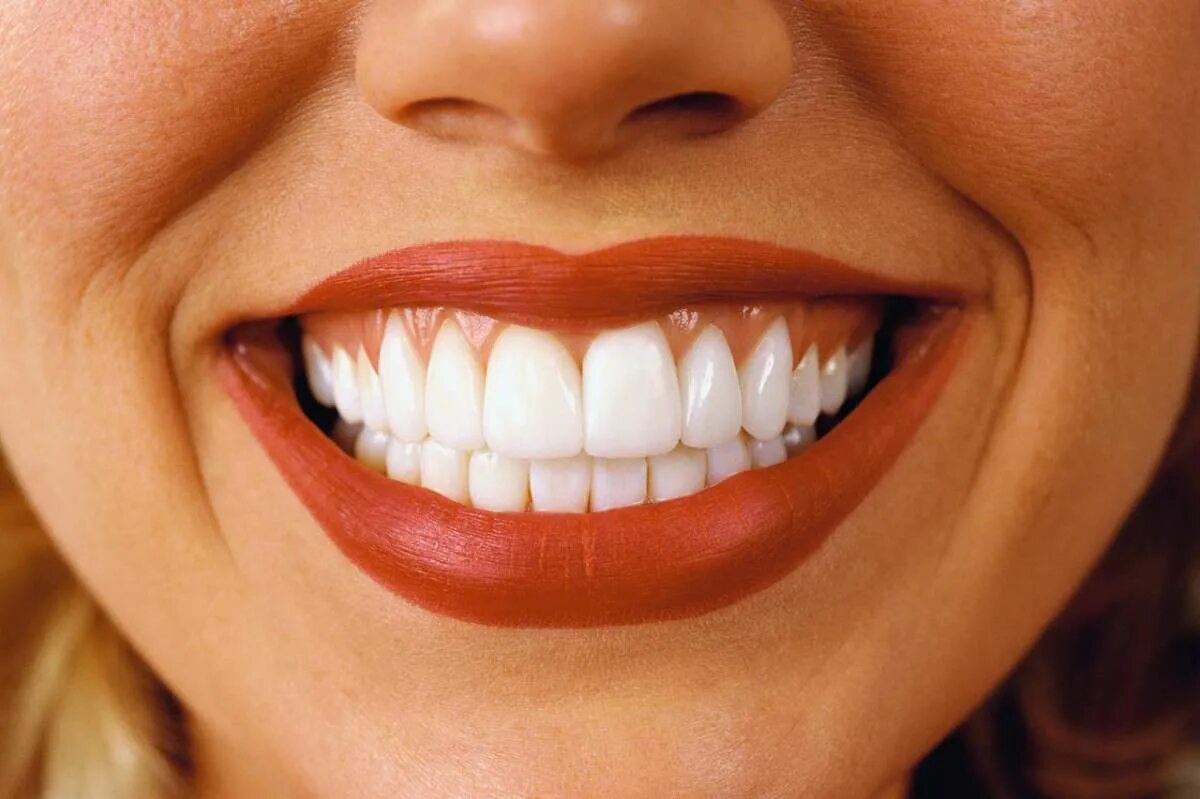 Голливудская улыбка виниры. Красивые зубы. Красивые ровные зубы. Разноцветные зубы.