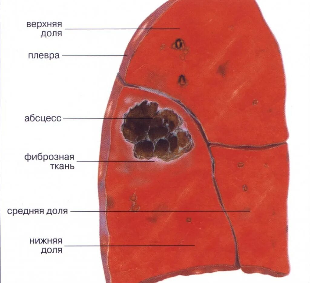 Кортикальный абсцесс легкого. Амебный абсцесс легкого. Гематогенный абсцесс легкого. Острый абсцесс легкого. Полость заболевания легких