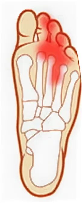 Болит подушечка ступни
