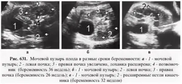Дивертикулез мочевого пузыря на узи. Мочевой пузырь у плода норма. Скрининг 1 мочевой пузырь. Узи исследования мочевого пузыря. Мегацистис у плода 12 недель.