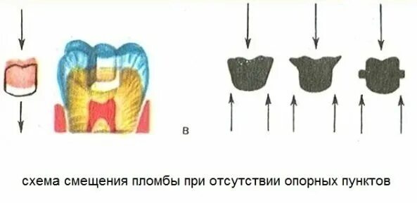 Иммунные зоны. Этапы препарирования кариеса. Этапы препарирования зубов при кариесе. Иммунные зоны зуба располагаются. Препарирование кариозной полости.