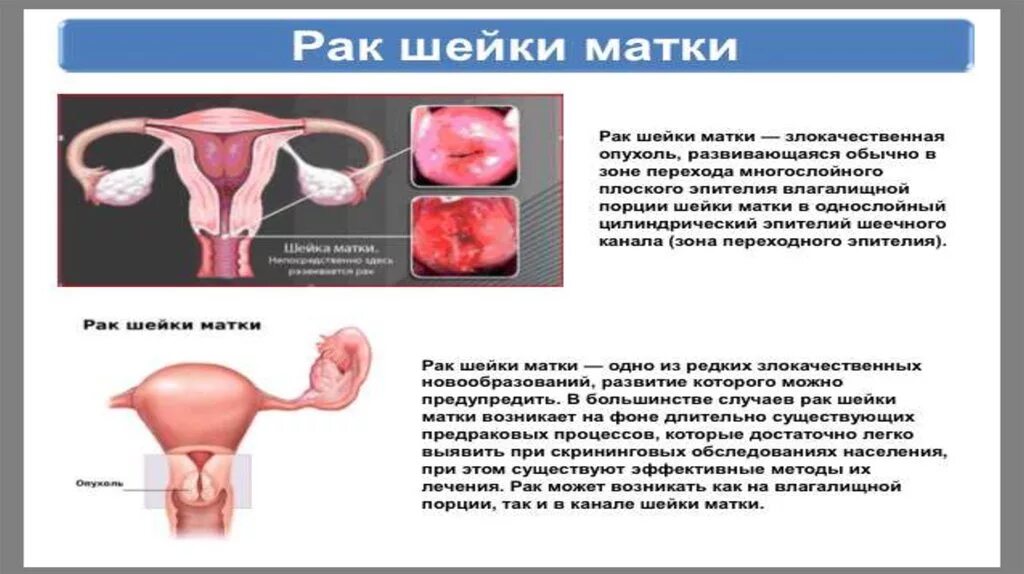 Симптомы ракмшейки матки. Злокачественная опухоль шейки матки.