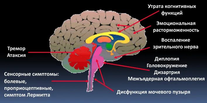 Нарушение функции мозжечка. Рассеянный склероз мозжечка. Рассеянный склероз поражение мозжечка. Поражение мозжечка при рассеянном склерозе. Мозг при рассеянном склерозе.