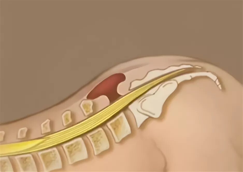 Спинномозговая грыжа. Спинномозговая грыжа spina bifida. менингоцеле спинномозговых корешков.