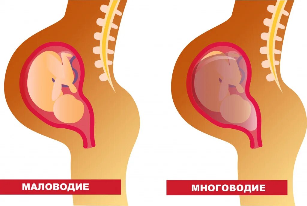 Что такое маловодие у беременной. Причины маловодия у беременных. Уменьшение околоплодных вод. Маловодье 38 неделя