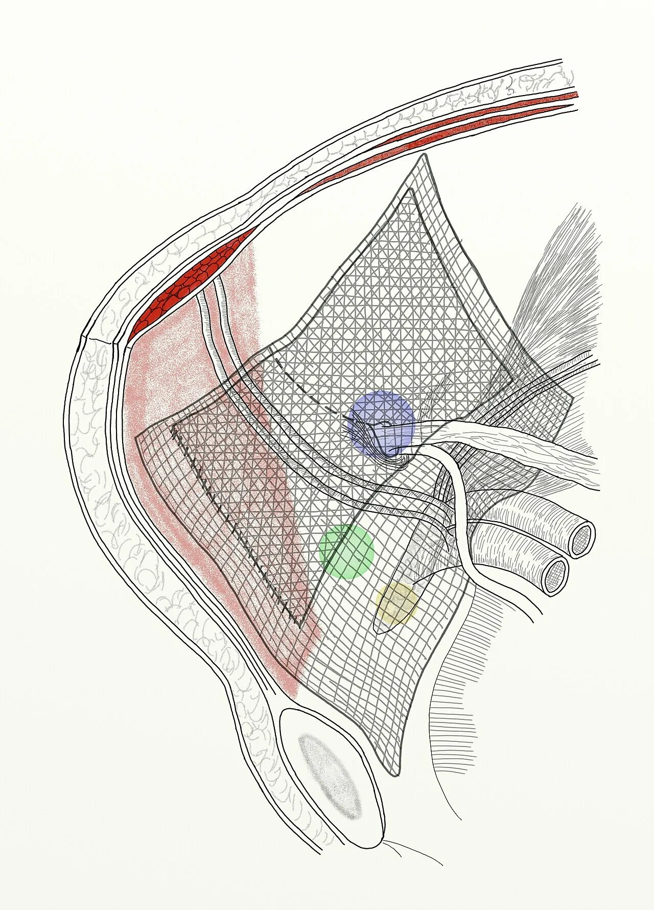 Паховая грыжа операция с сеткой. Сетка для герниопластики грыжи. Сетка для операции на грыжу