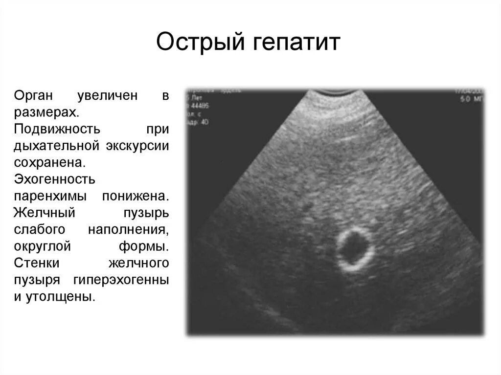 Гепатит желчный пузырь. Острый гепатит УЗИ картина. УЗИ картина печени при гепатите. Хронический гепатит УЗИ картина. Острый гепатит на УЗИ признаки.