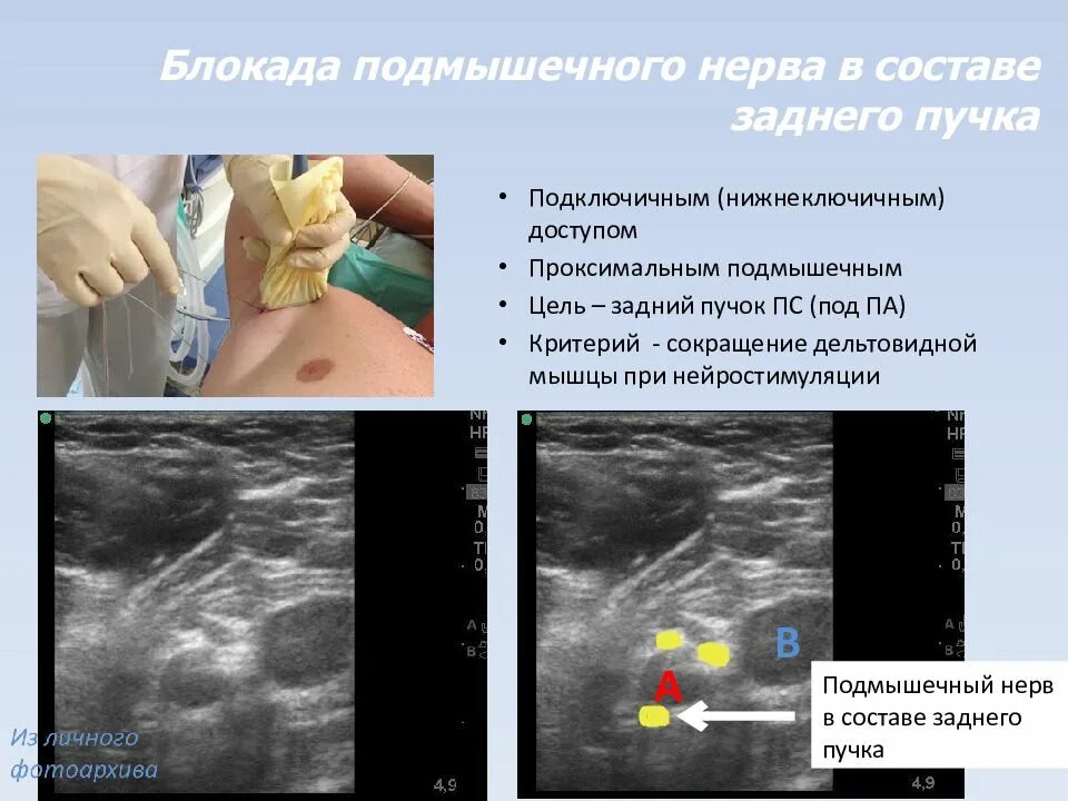 Блокада сплетения. Блокада плечевого сплетения УЗИ. Это блокада нерва под УЗИ контролем. Подмышечная блокада под УЗИ. Блокада плечевого сплетения подмышечным доступом.