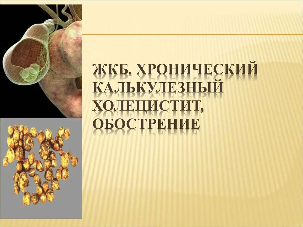 ЖКБ. Хронический калькулезный холецистит, обострение.. ЖКБ, флегмонозный калькулезный холецистит. Обострение хронического калькулезного холецистита. Хронический калькулёзный холесцит. Мкб жкб калькулезный