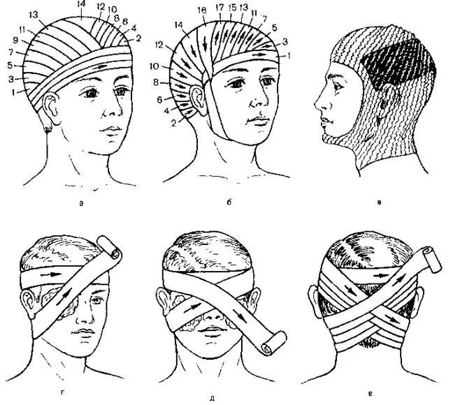 Бинтование чепец. Перевязка головы бинтом чепец. Повязка чепец при ранении головы. Бинтование десмургия чепец. Как перевязывать голову