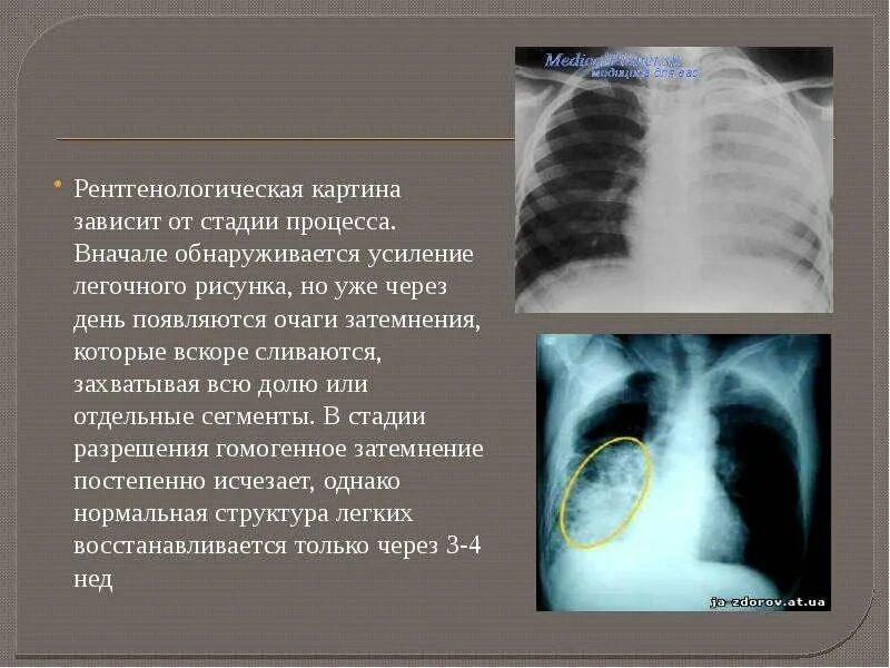 Усиленный легочный рисунок. Усилен сосудистый рисунок легких. Легочный рисунок усилен по сосудистому типу. Затемнение легочного рисунка.