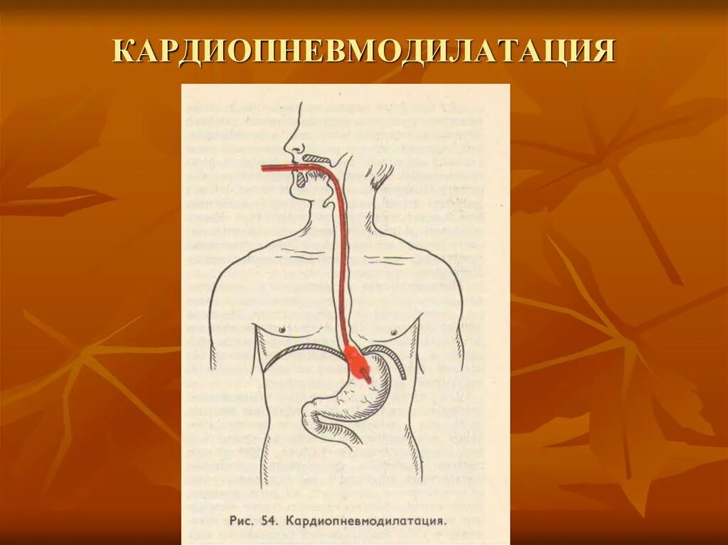 Стенд пищевода. Заболевания пищевода презентация. Пищевод схема. Хирургические болезни пищевода. Пластика пищевода по ру-Герцену-Юдину презентация.