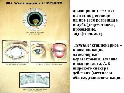Иридоциклит дифференциальная