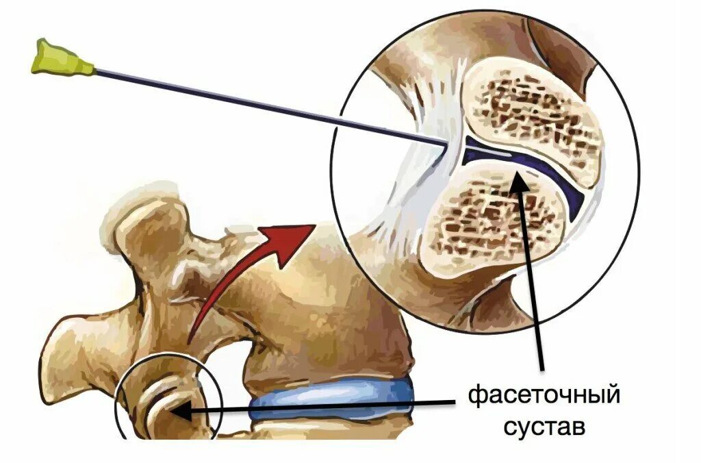 Фасеточная блокада. Фасеточные суставы позвоночника. Фасеточные суставы поясничного отдела. Спондилоартроз фасеточный синдром. Фасеточный сустав шейного отдела.