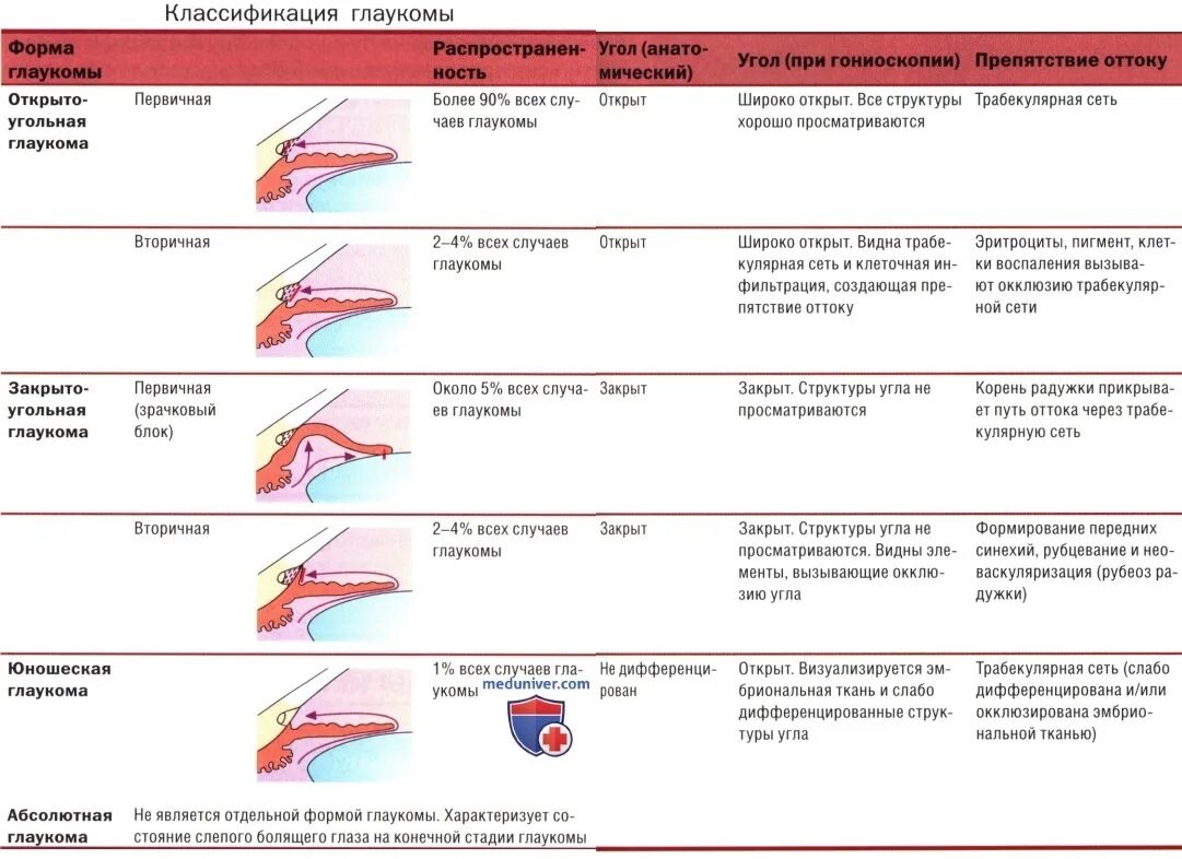 Первичная закрытоугольная глаукома классификация. Классификация вторичной глаукомы по стадиям. Классификация открытоугольной глаукомы по стадиям. Классификация глаукомы по уровню ВГД. Классификация глаукомы