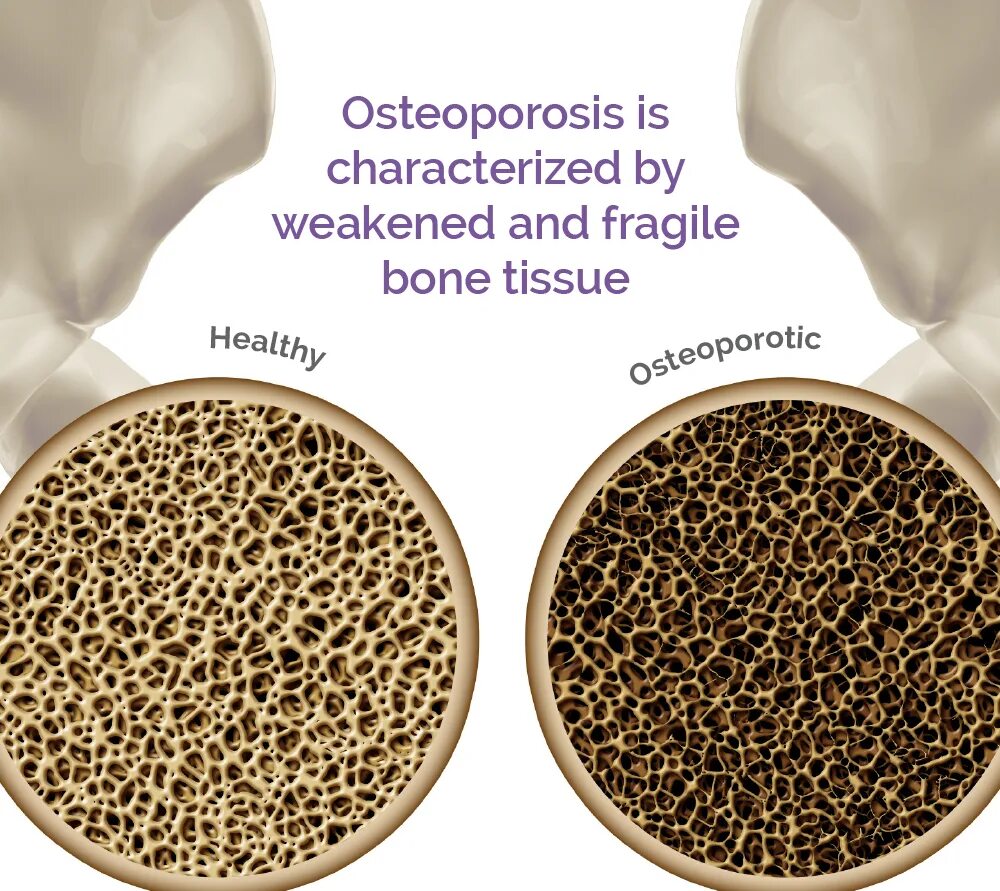 Osteoporosis Type 1. BMC Osteoporosis. Capsule for Osteoporosis. Stellar Osteoporosis.