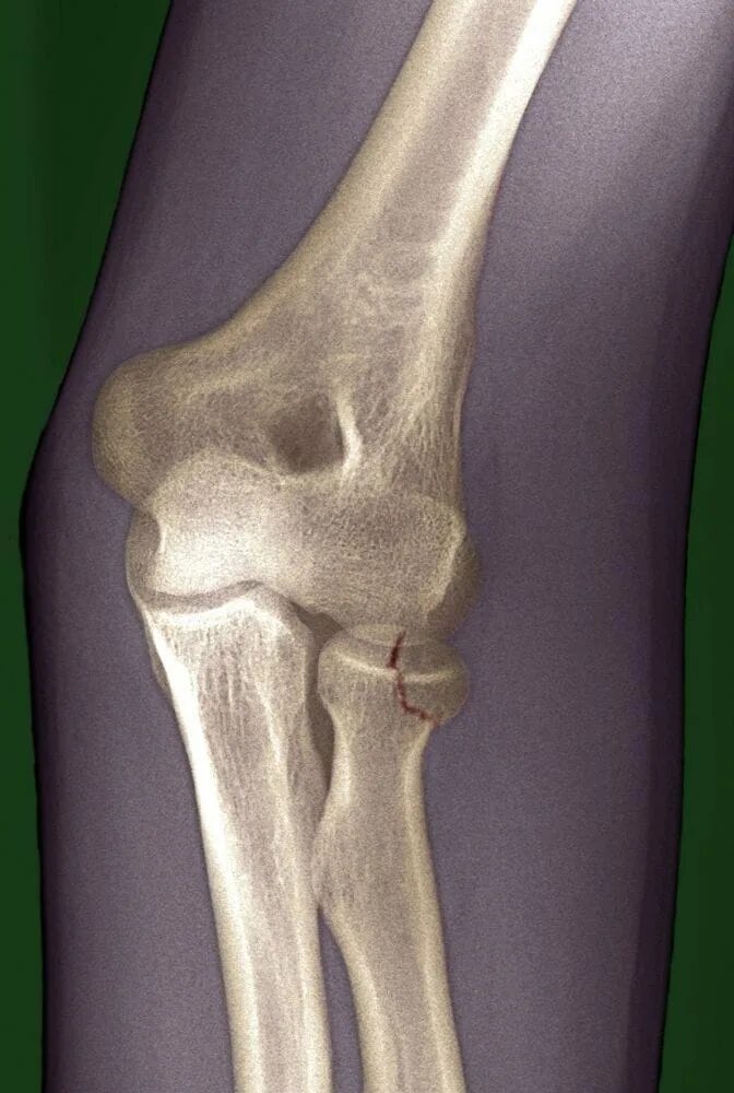 Перелом головки лучевой кости рентген. Внутрисуставной краевой перелом головки лучевой кости. Субкапитальный перелом лучевой кости. Внутрисуставной перелом головки лучевой кости.