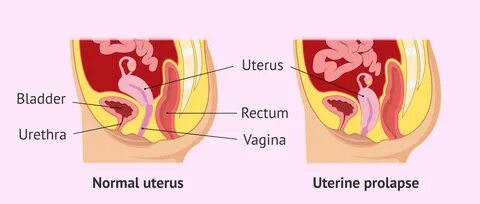 uterine prolapse, prolapsed uterus