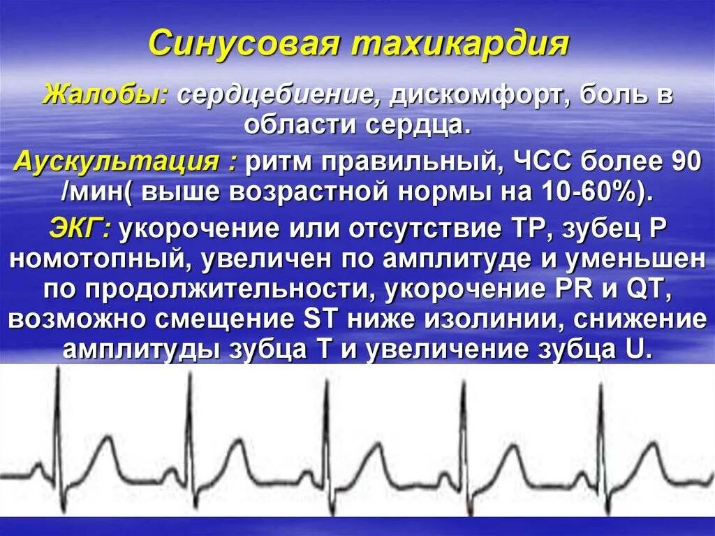 Лечение тахикардии при нормальном давлении. Синусовая тахикардия. ритм синусовая тахикардия. синусовая тахикардия сердца что это такое. при синусовой тахикардии :.