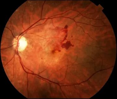 Age related macular degeneration
