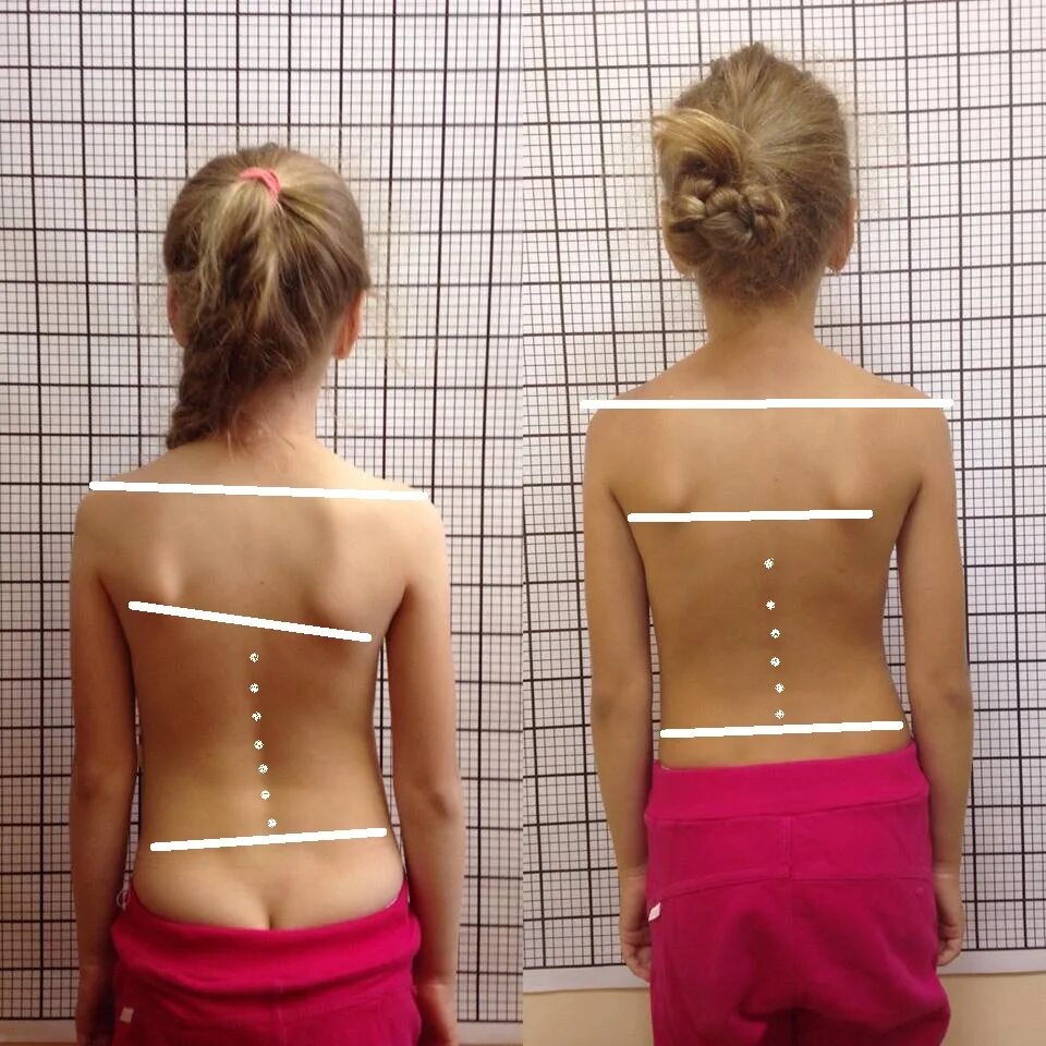 асимметрия тела и перекос таза. соматоскопия осанки. искривление позвоночника перекос таза. прямая спина мужчины. сколиоз костей таза.