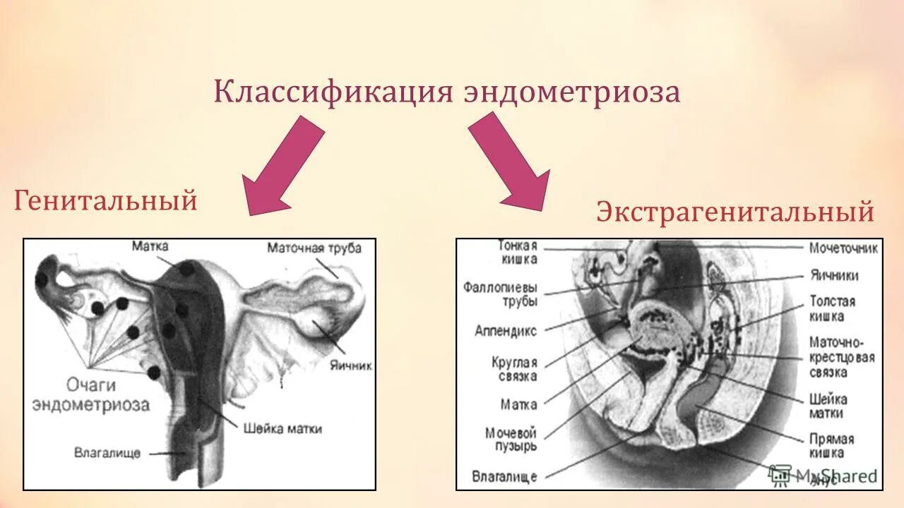 Классификация наружного генитального эндометриоза. Стадии эндометриоза внутреннего схема. Симптомы наружного генитального эндометриоза. Наружный генитальный эндометриоз формы.